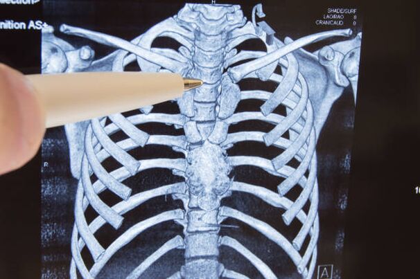 Osteocondroza coloanei lombare | Site-ul oficial Hondrogel